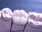 molaire prothèse dentaire.jpg